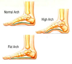 sports medicine: Pes Planus (flat foot)