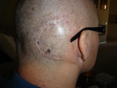 3 Weeks - Scar is healing nicely