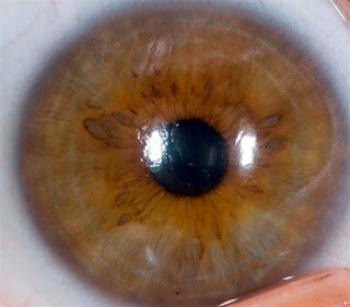 iridology of iris and eye 
