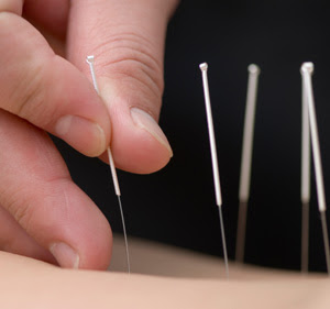 acupuncture acupuncture