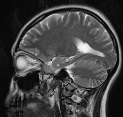 Neuroradiology On the Net: Neurocysticercosis (Calcified stage)