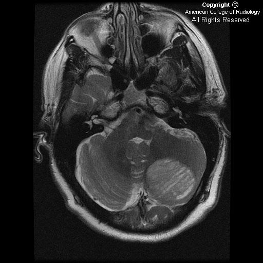 Neuroradiology On the Net LhermitteDuclos disease (LDD)