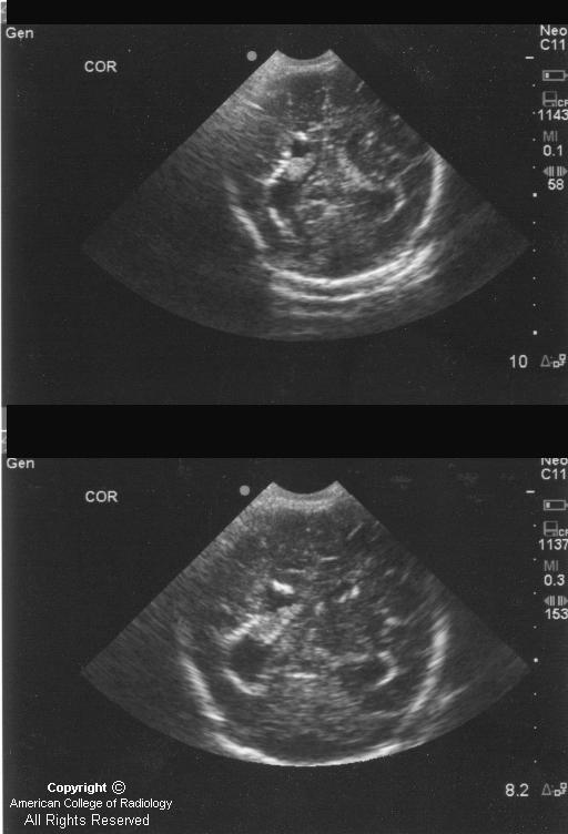 Neuroradiology On the Net Congenital Cytomegalovirus infection