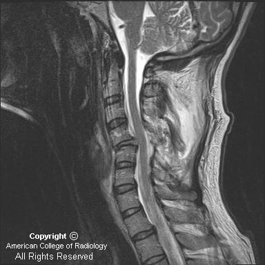 Neuroradiology On the Net: Anterior subluxation of C4 on C5, with other imaging demonstrating unilateral locked left facet and right facet at C4-C5.