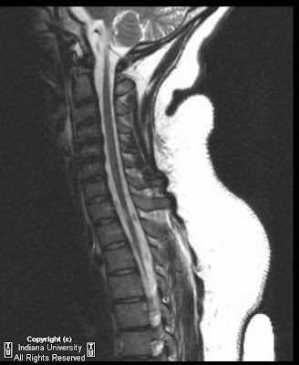 myelomalacia cord spinal traumatic multiple avulsion plexus atrophy secondary brachial neuroradiology