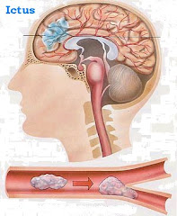 SCOPERTO L'ENZIMA RESPONSABILE DEL DANNO CEREBRALE DOPO L'ICTUS