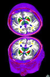 Compromised Myelin