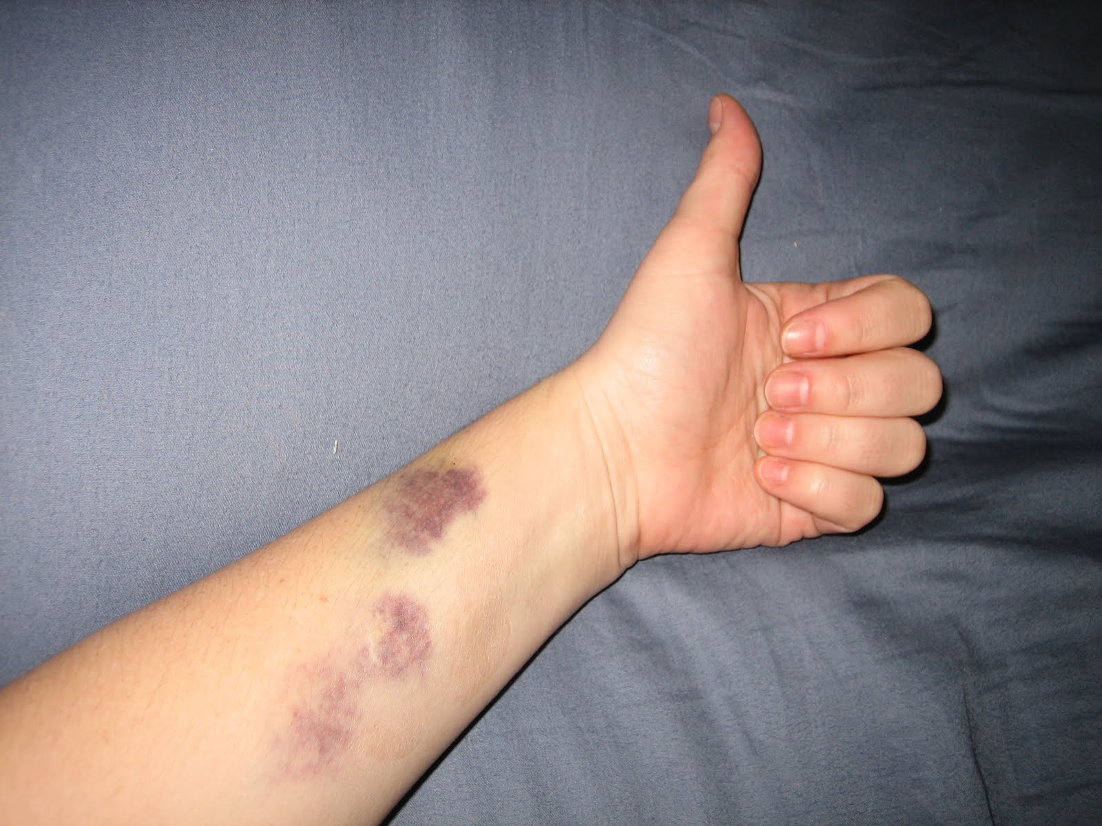 Eclipse of the Heart I'm So Glad My Wrists Hurt