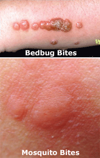 Flea Bites on Humans — Pictures, Treatment & Prevention