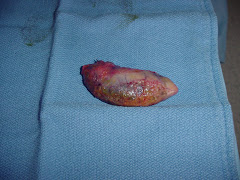 The Gallbladder. Or a slug.
