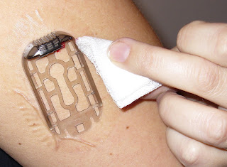 Diabetes Life Balance: CGM: Inserting a Sensor (Photos)