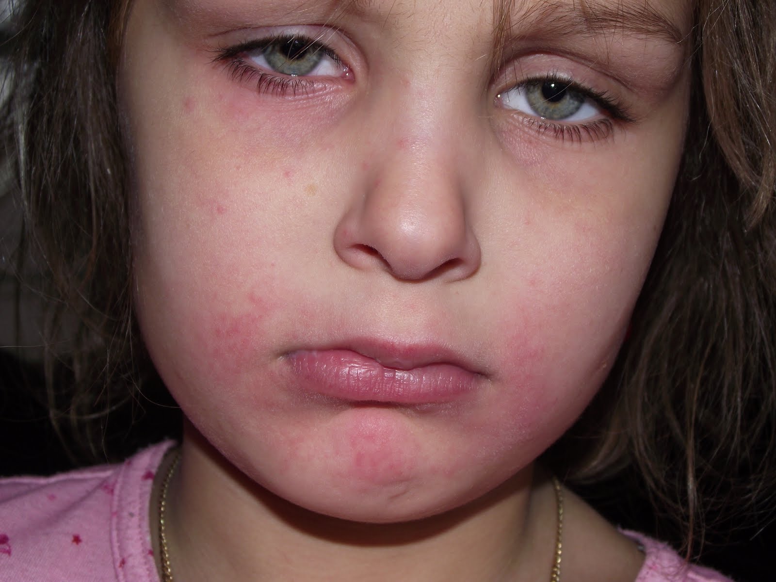 Green and Bitchy Jovie's UNcured Anaphylactic Peanut Allergy