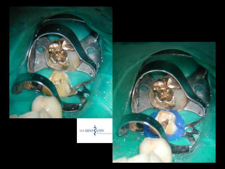 Implantdentistry and related topics Once you remove a crown... you