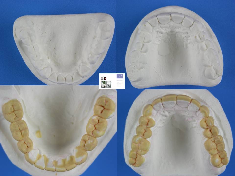 Implantdentistry and related topics: Wax up of study casts for correct ...