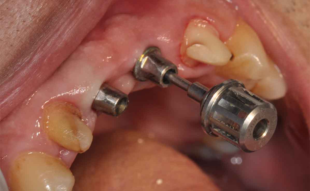 Treatment Options Dental Implant