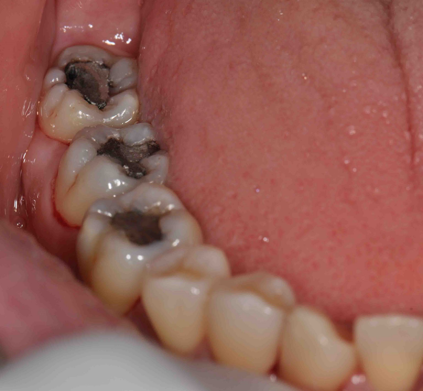 Treatment Options Dental Aesthetic with White Filling II Treatment Options Dental Aesthetic with White Filling II
