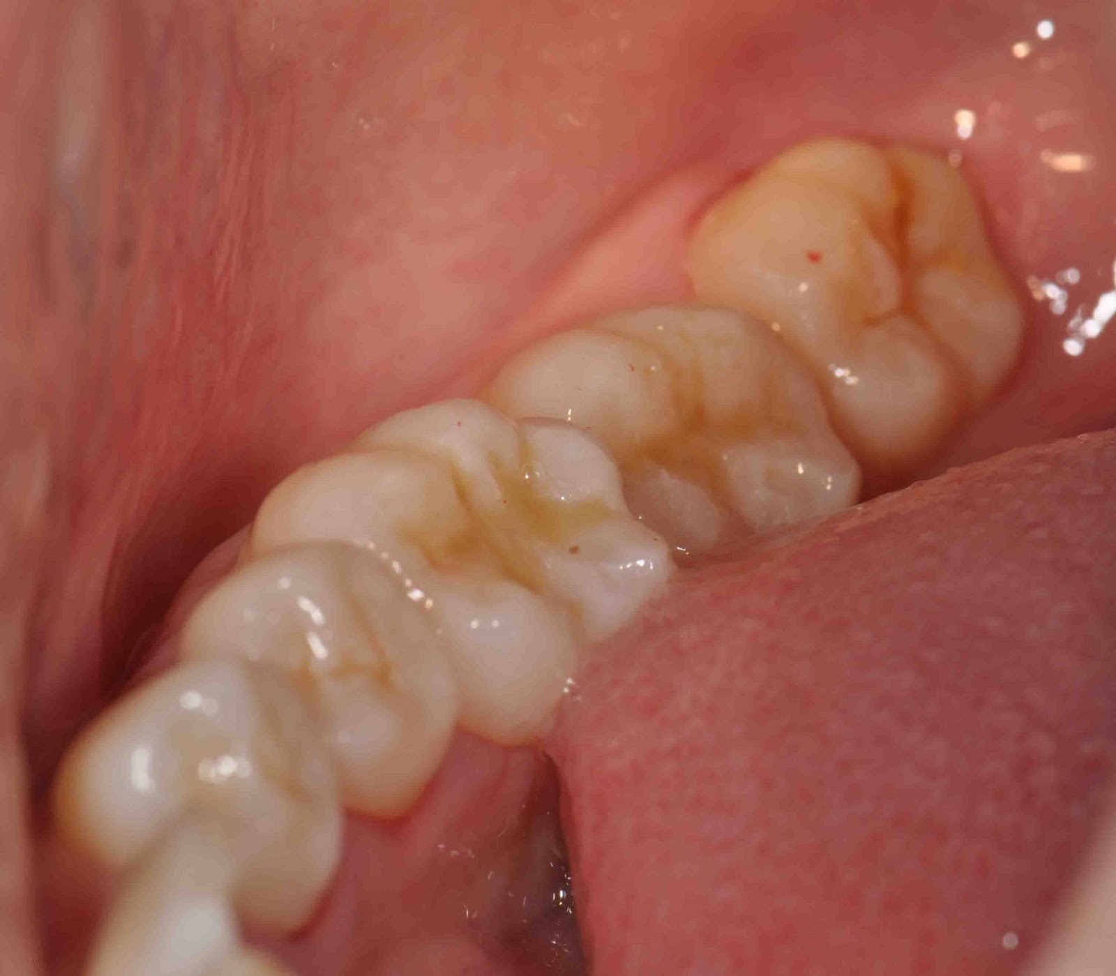 Treatment Options: Dental Aesthetic with White Filling II ...