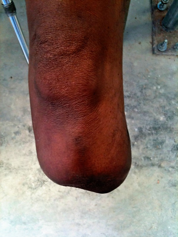 prosthetic availability in haiti Perspective from the new england journal of medicine — the earthquake in haiti — dispatch from port-au-prince and the availability prosthetic-valve. prosthetic availability in haiti Perspective from the new england journal of medicine — the earthquake in haiti — dispatch from port-au-prince and the availability prosthetic-valve.