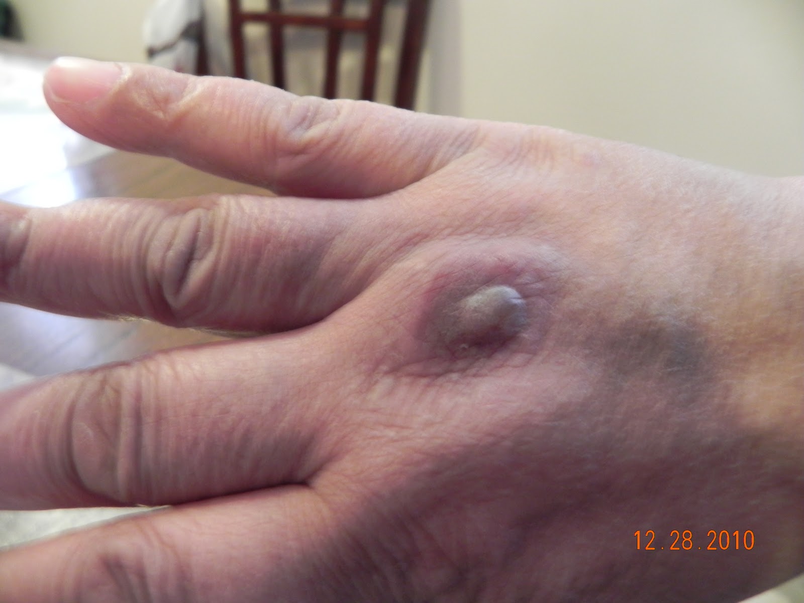 Me Verse Lupus Ugly rashes