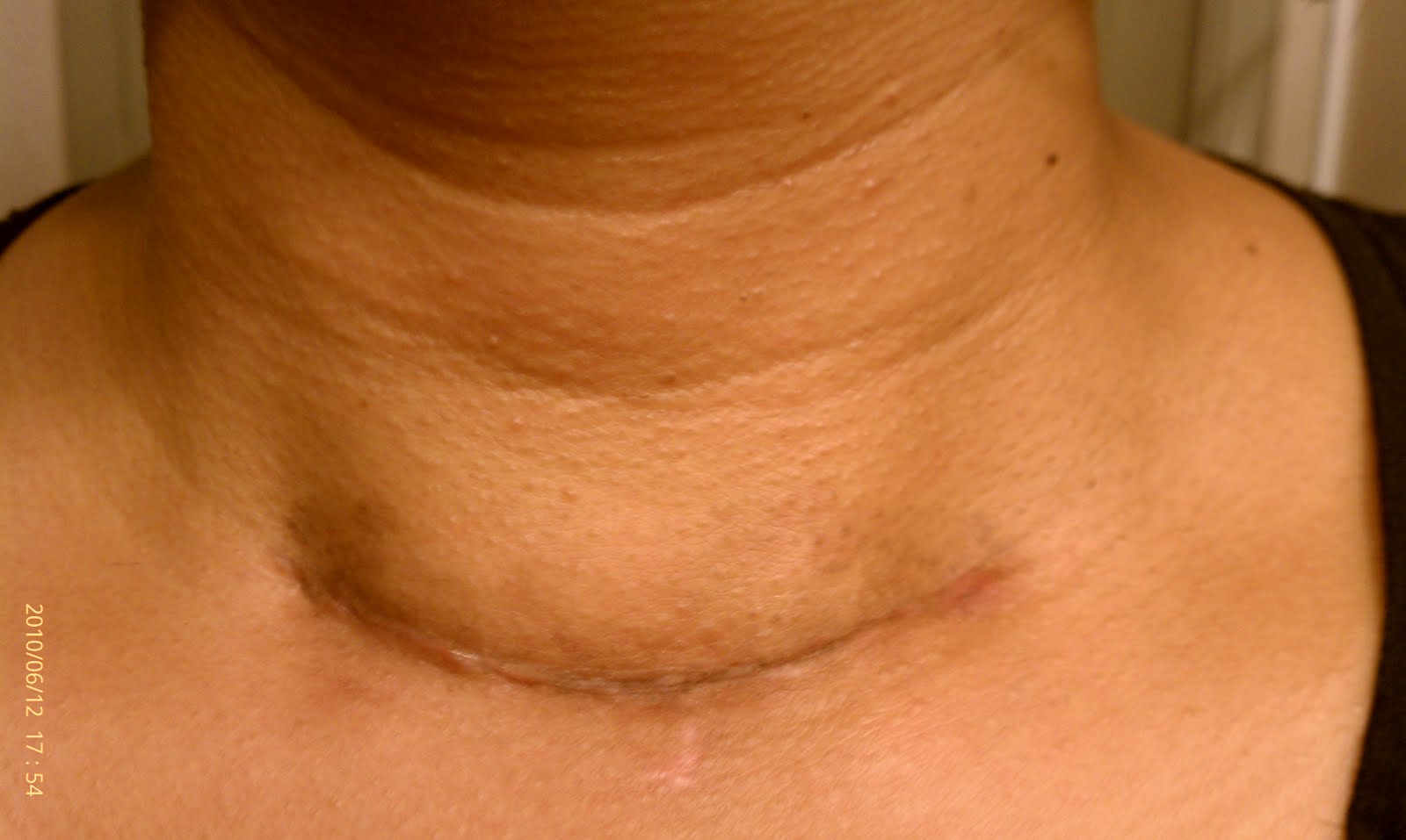 How does my neck look? June 2010