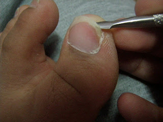 treat care for nail crack