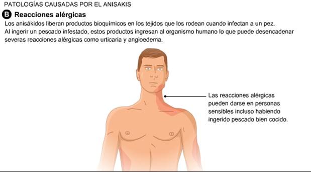 Anisakis Simplex Alergia Alimentaria | . . Anisakis Simplex