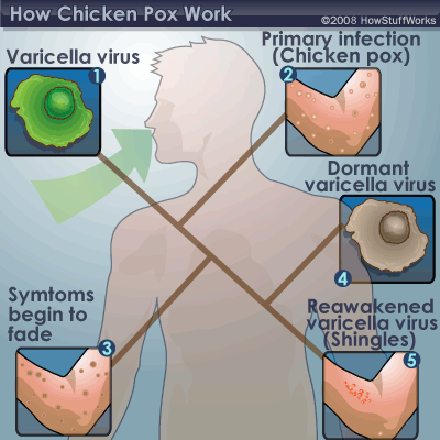 Chickenpox - Wikipedia