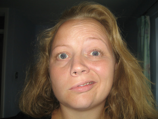 30 year old woman with bells palsy for 5 days