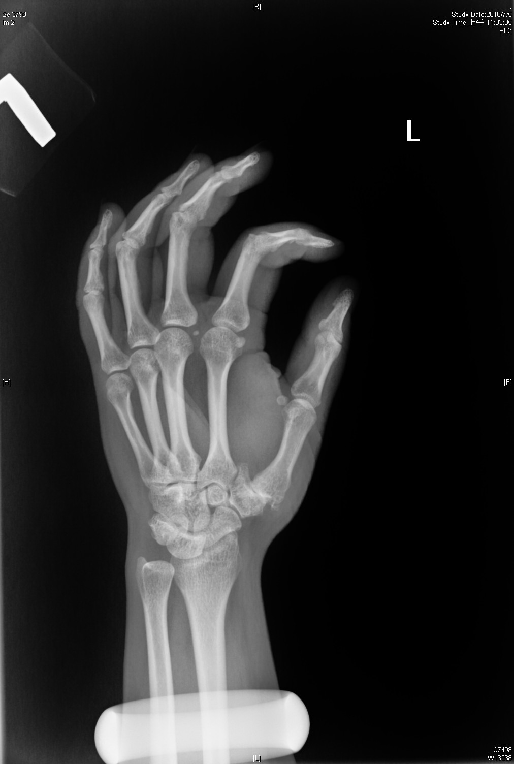 Big Bad Basal joint OA with subluxation