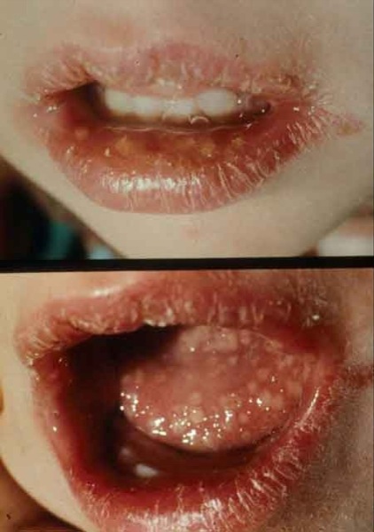 Herpes labialis - Wikipedia