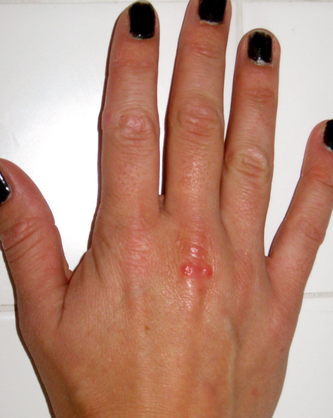 Aimee's Thoughts Today: Ew! Warts!