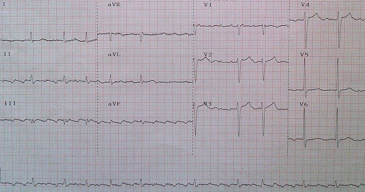 Phimaimedicine: 736. Atrial flutter with variable AV(conduction) block