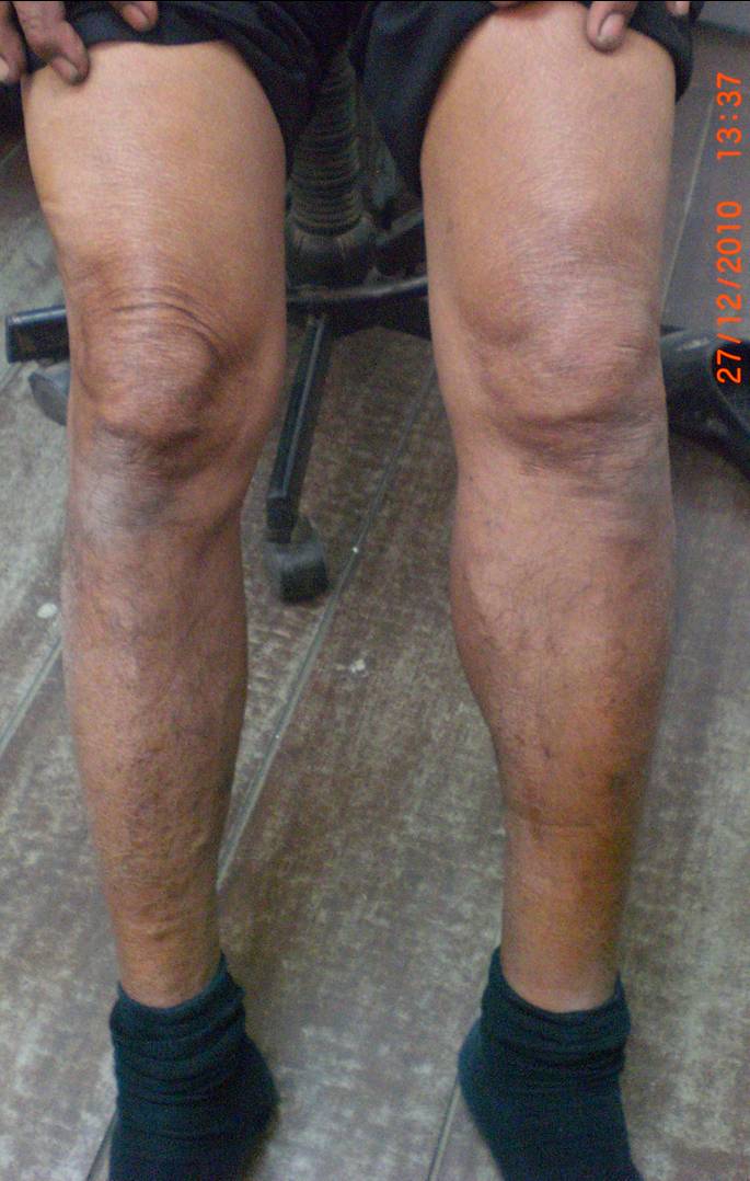 phimaimedicine-947-spontaneous-calf-hematoma
