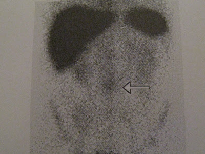 Nuclear Medicine - Another Way Of Learning: LABELLED WHITE BLOOD CELL ...