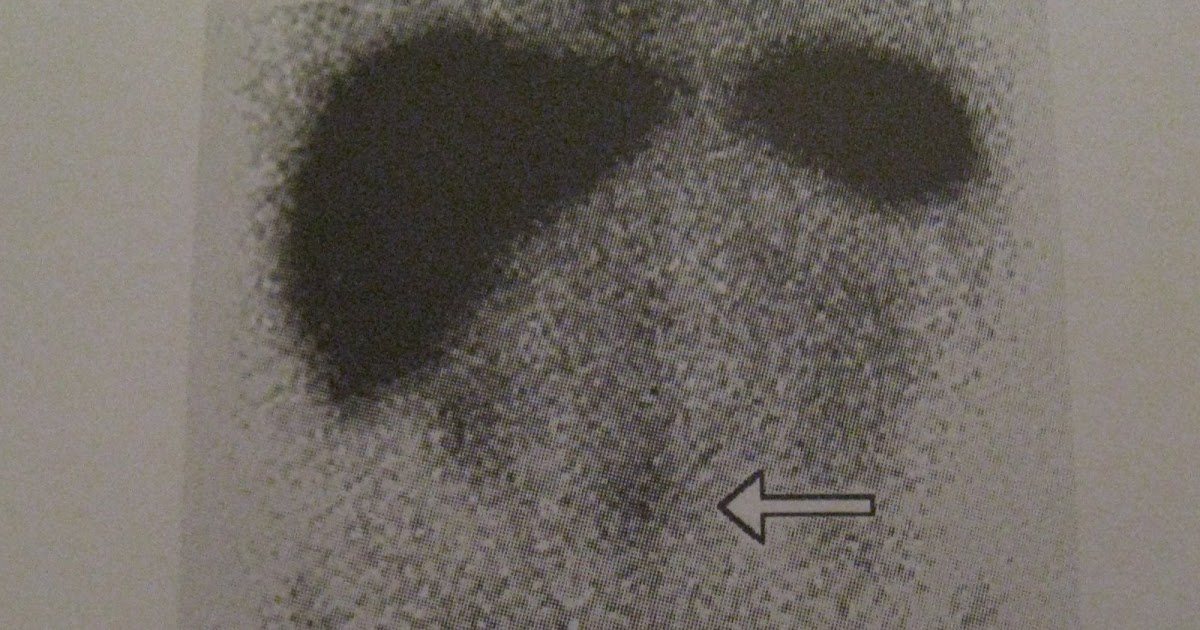 White Blood Scan Fr Nuclear Medicine - Another Way Of Learning: LABELLED WHITE BLOOD CELL