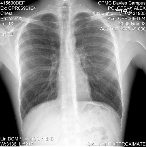 [Chest+x-ray+after+gay+bashing.jpg]