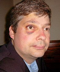 Manfred Rouhs’ black eye