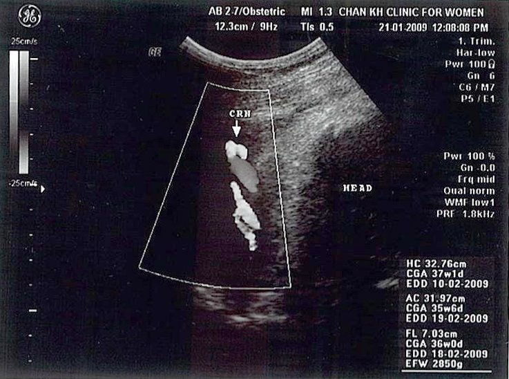 [ultrasound+scan+39+weeks2.jpg]