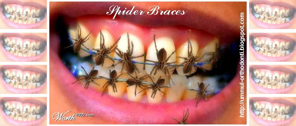 O R T H O D O N T I Kawat Gigi Laba Laba Spider Braces O R T H O D O N T I Kawat Gigi Laba Laba Spider Braces