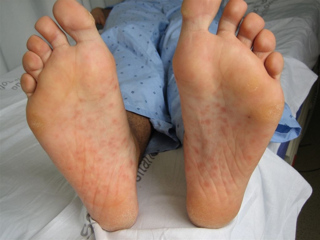 Roseola (Sixth Disease) Condition, Treatments, and ...
