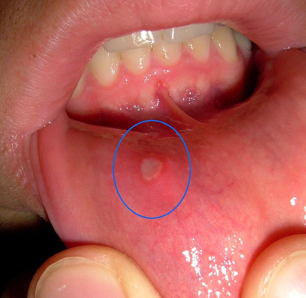 Water Blisters In The Mouth 6