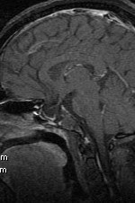 Empty Sella and CSF Rhinorrhea-MRI & CT - Sumer's ...
