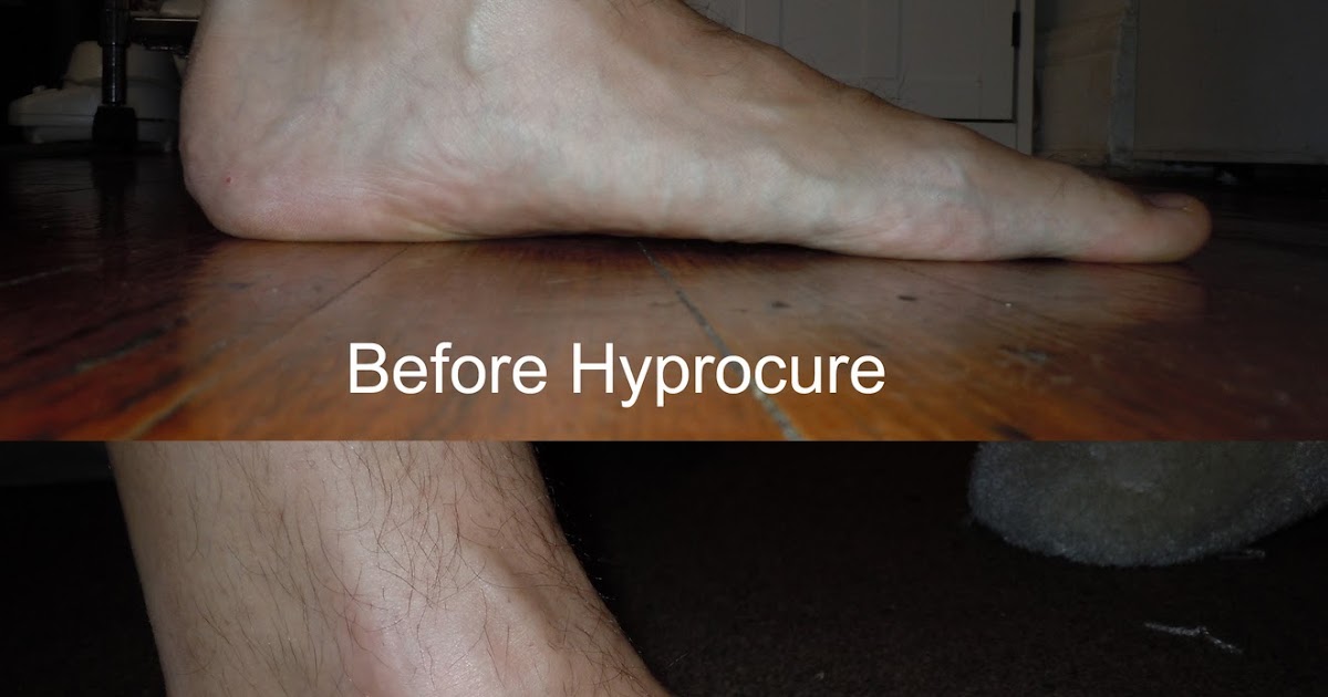 Hyprocure Implant Flat Feet Corrective Surgery 3 Months After Surgery