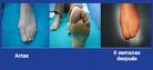 Juanete Hallux Valgus