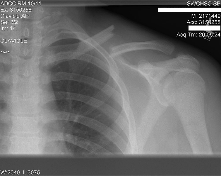 KWI Airsoft OPERATION BROKEN COLLAR BONE