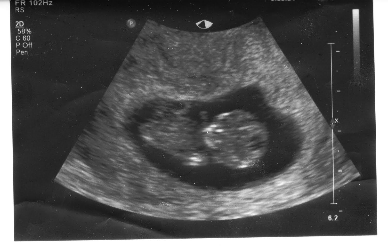 Симптомы 10 недели. Как выглядит ребенок на УЗИ В 10 недель. УЗИ 9-10 недель беременности. УЗИ на 10 акушерской неделе беременности.