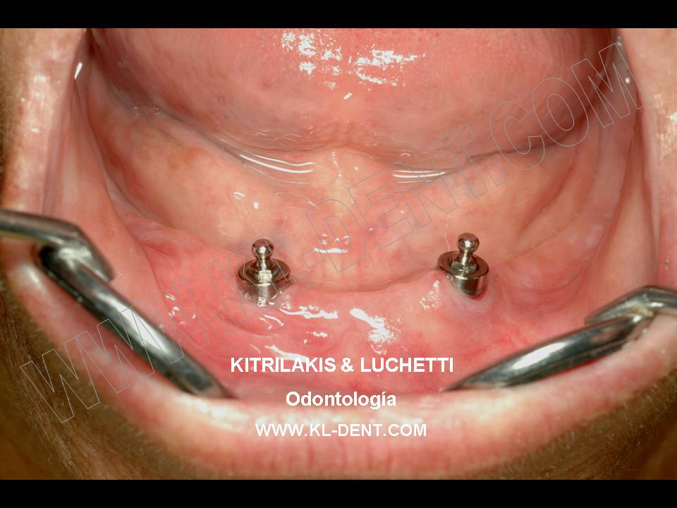 Kitrilakis & Luchetti Odontología Implantes Dentales