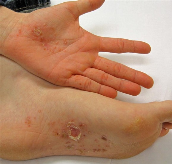 Eczema Treatment, Home Remedies, and Causes
