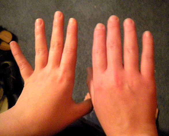swollen red hands - Women's Health - MedHelp