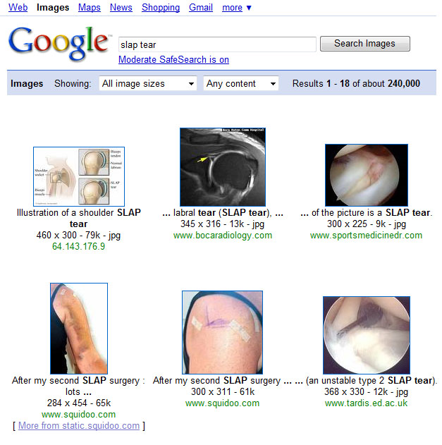 slap tear with torn labrum